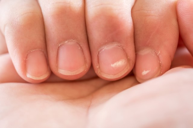Šta nam govore bele linije na noktima - ima li razloga za brigu?